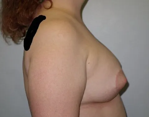 breast augmentation reno