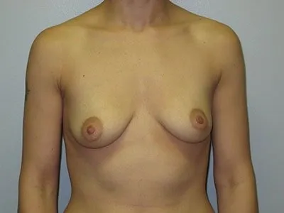 breast augmentation reno